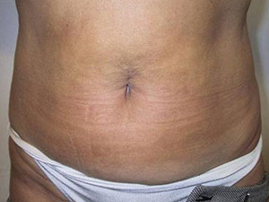 aqualyx po aqualyx po